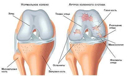 artroz-kolennogo-sustava